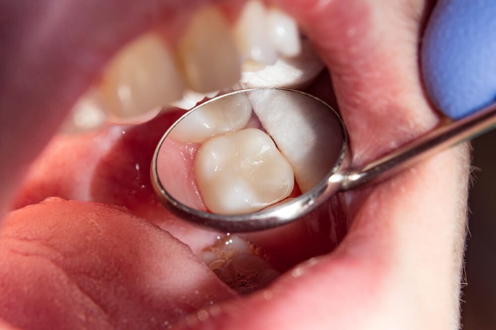 dentist examining teeth with a composite filling