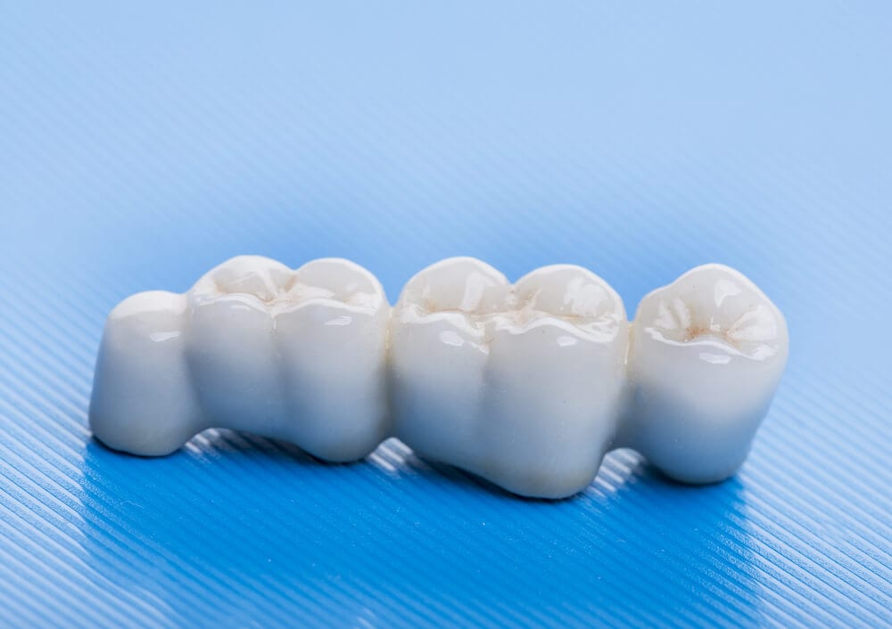 stand-alone Porcelain crowns