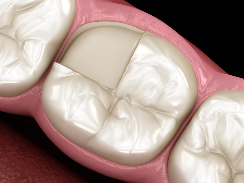 porcelain onlay being laid into teeth