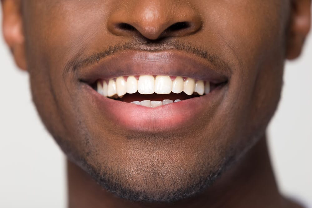 african american male with straightened teeth